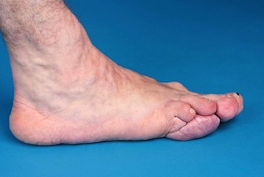 Cerebriformer Mixed Connective Tissue Nevus bei Proteus-Syndrom