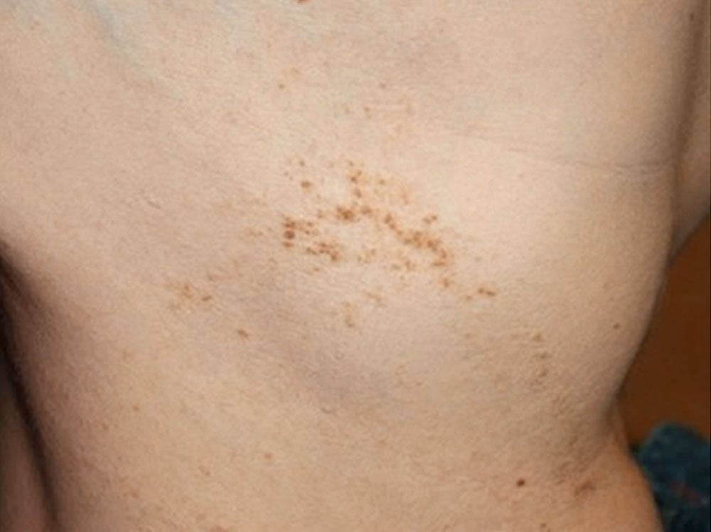 Epidermalnävus bei Patient mit Proteus-Syndrom