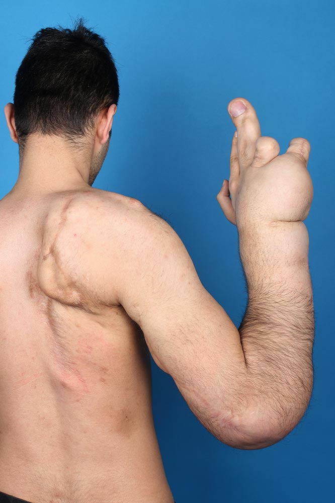 Fibrolipomatöser Gigantismus – rechter Körperquadrant