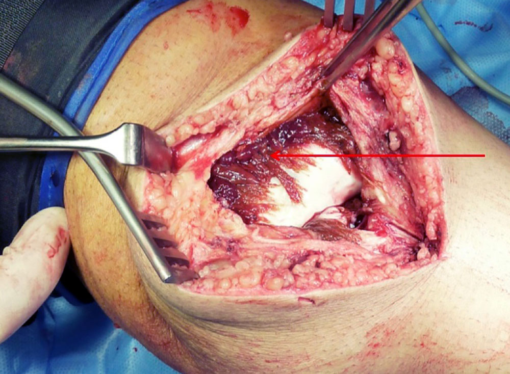 Operation – Synovitis Kniegelenk