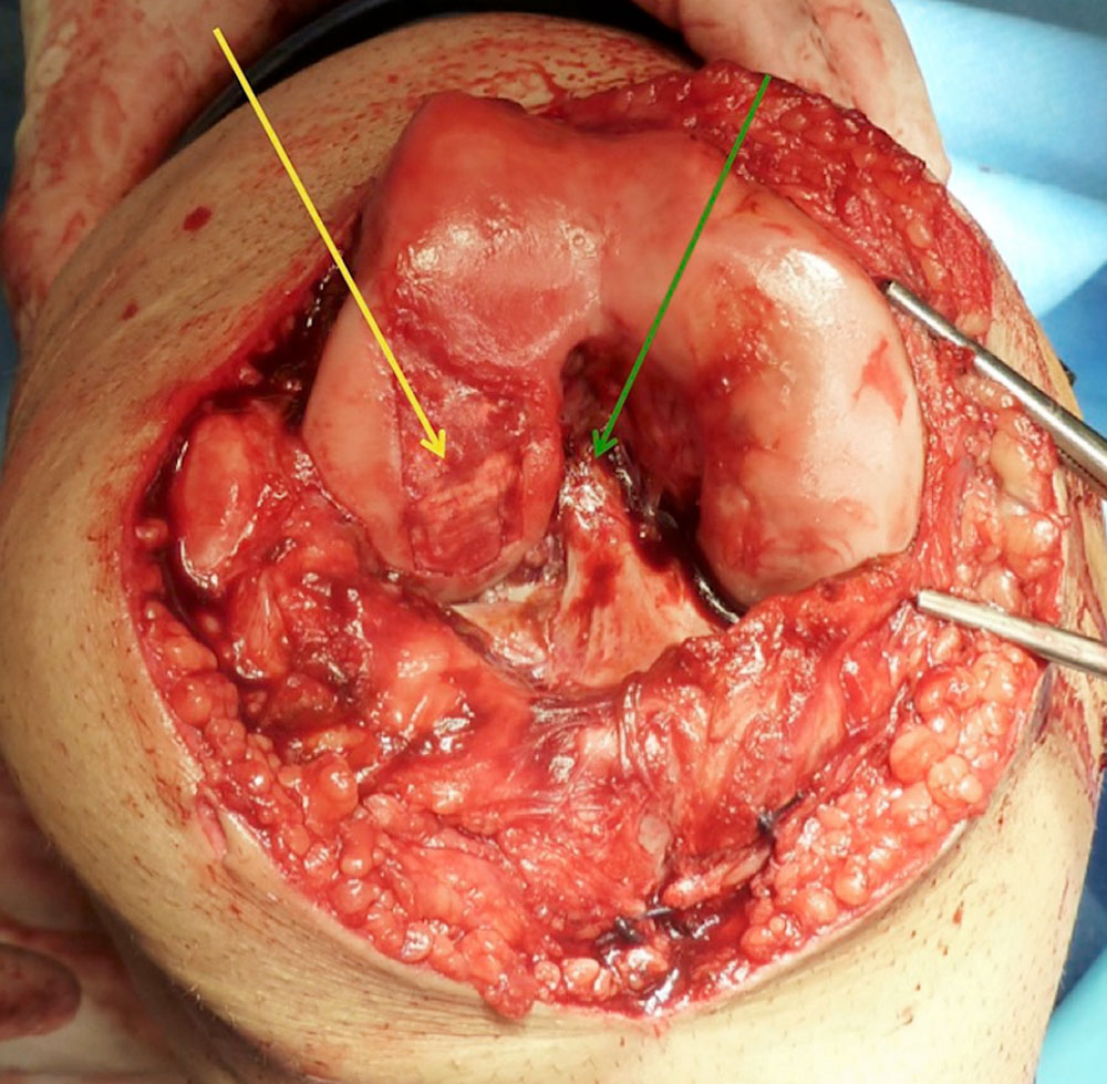 Operation – Knorpelersatz Knie