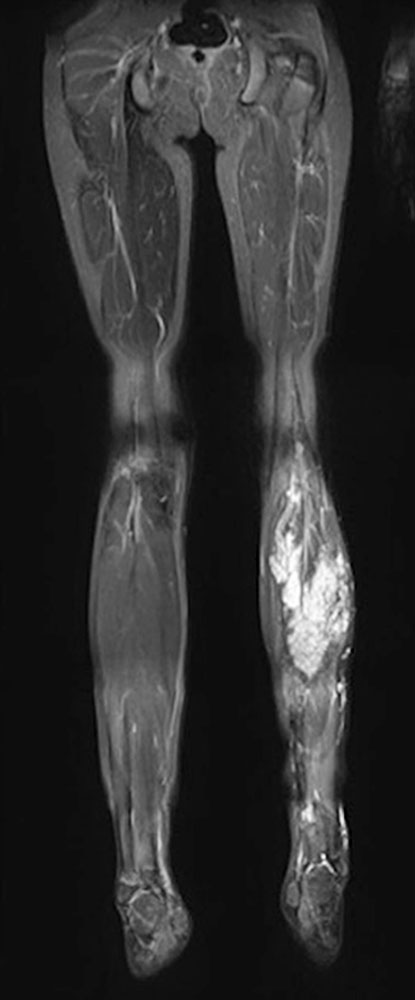 MRT – Infiltration des Muskulus gastrocnemius – Wadenmuskulatur