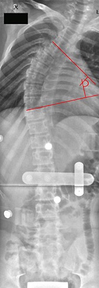 Messung des Cobb Winkels im Röntgenbild