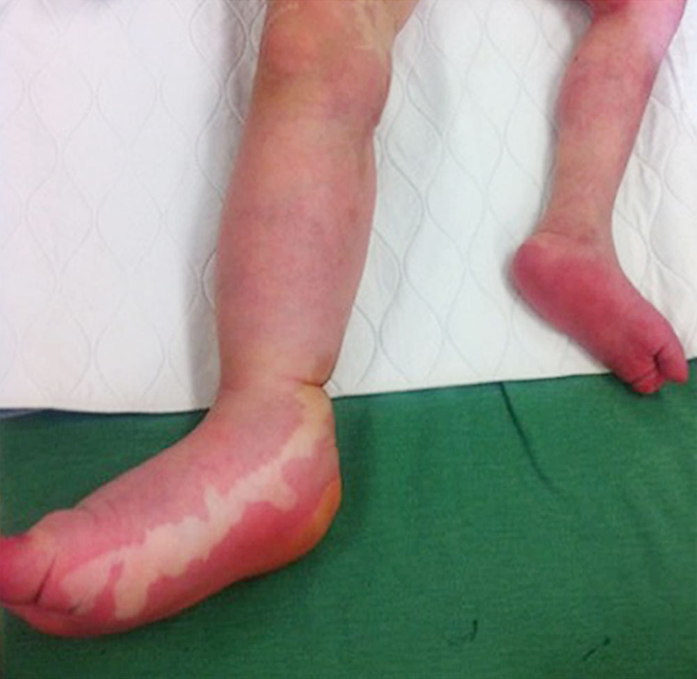 Patient mit CLOVES-Syndrom bei Schuhgröße 45