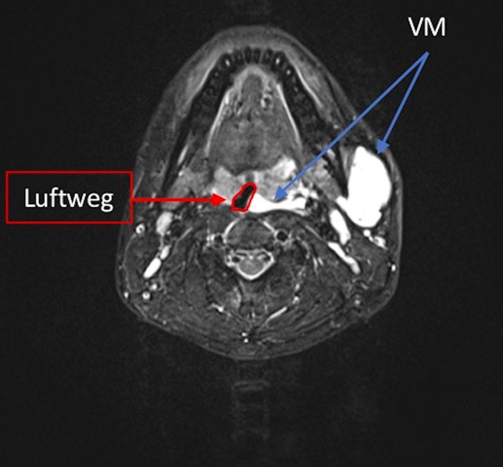 Venöse Malformation am Hals