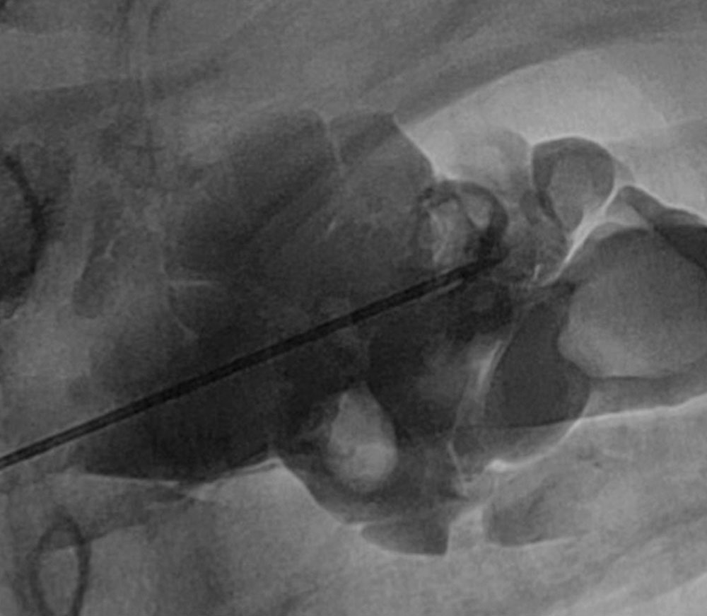 Narkose bei venöser Malformation am Hals
