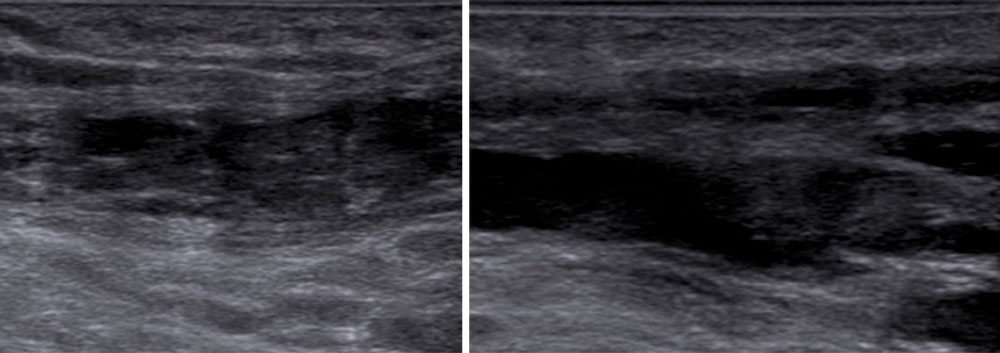 Sonographie – Thrombose der Vena femoralis communis