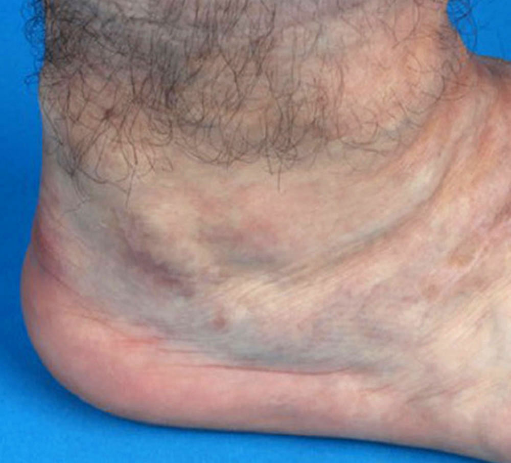 Patient mit venöser Malformation