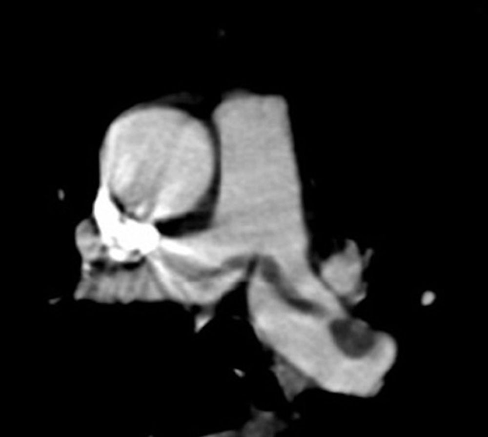 Computertomographie – Thrombus bei Lungenembolie