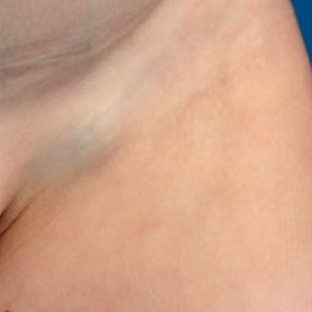 Thrombophlebitis bei venöser Malformation in Leiste