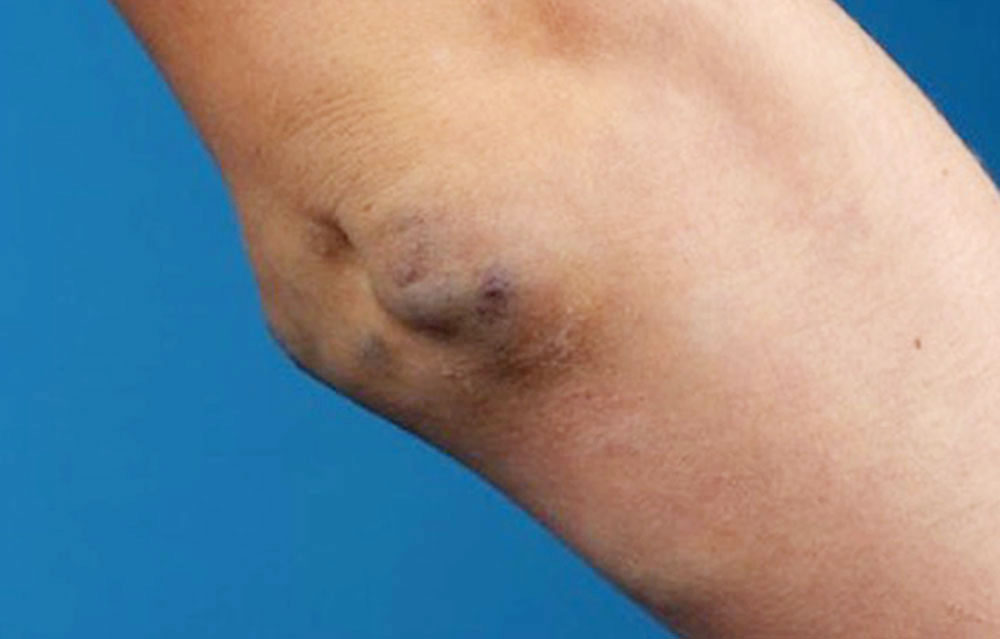 Thrombophlebitis am Ellenbogen