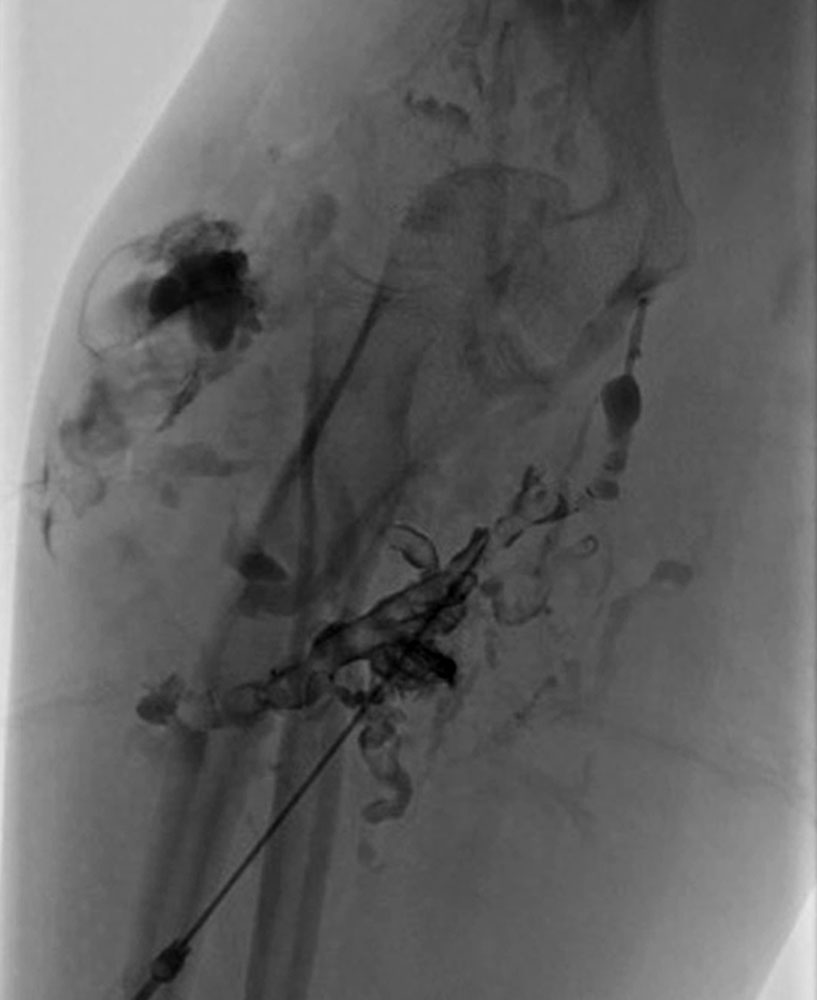 Varikographie von Thrombophlebitis