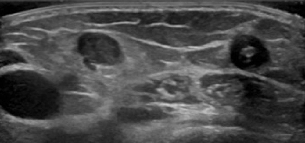 Sonographie von Blutgerinnseln in einer oberflächlichen Vene