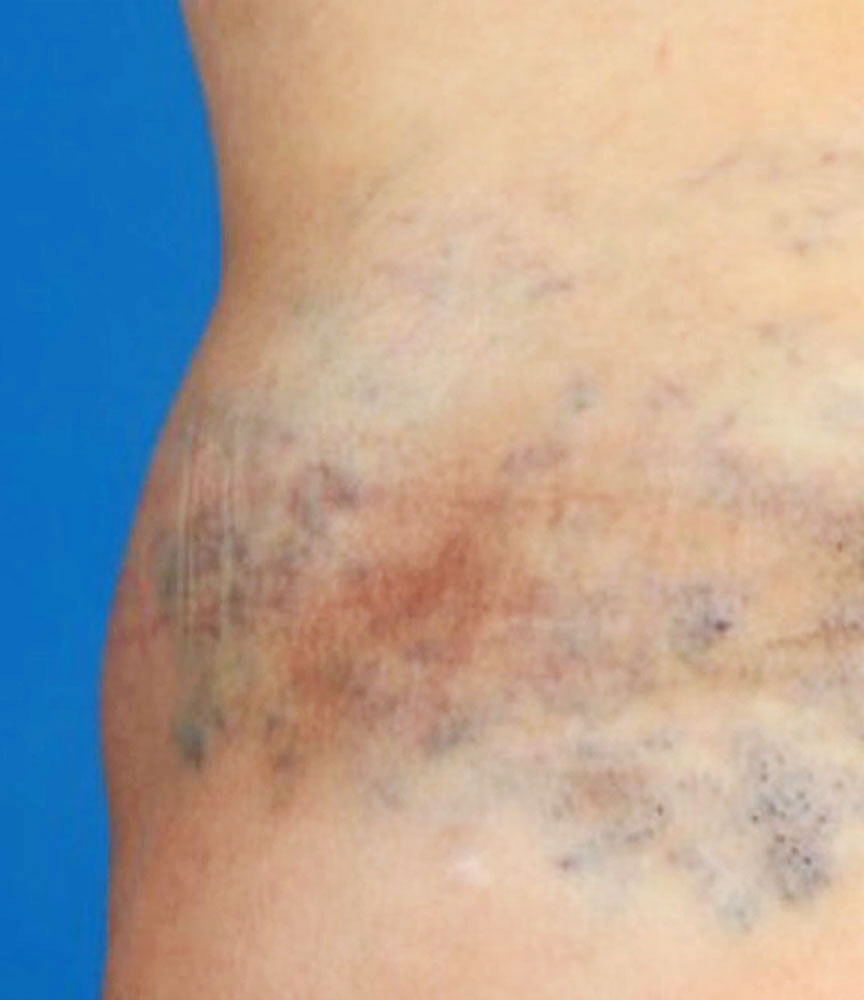 Venöse Malformation an der Flanke mit Thrombophlebitis