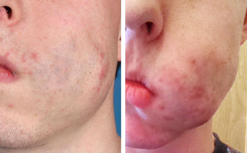 Thrombophlebitis bei einer venösen Malformation an Wange