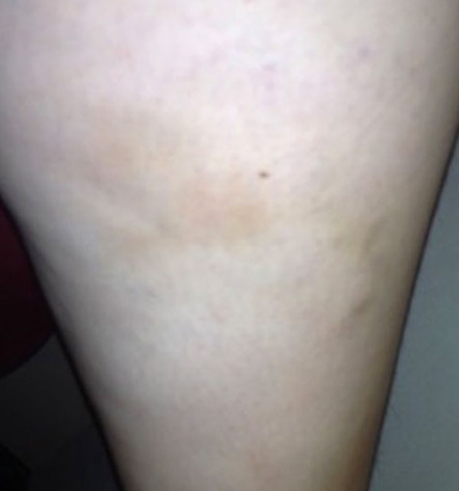 Oberflächliche Thrombophlebitiden in einer venösen Malformation am Oberschenkel