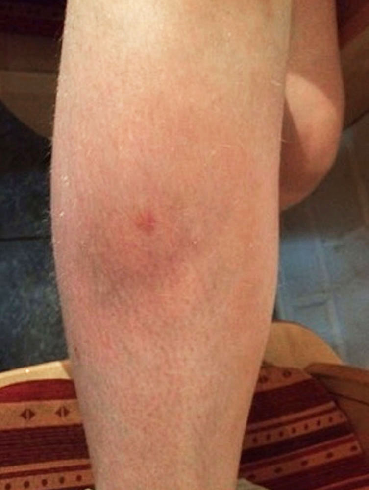 Thrombophlebitis am Unterarm