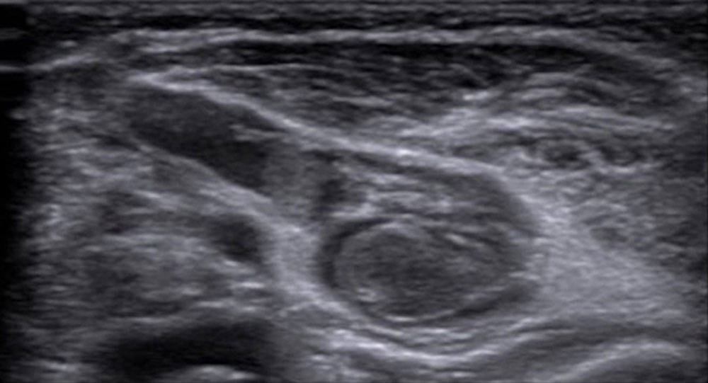 Sonographisches Bild eines frischen Thrombus