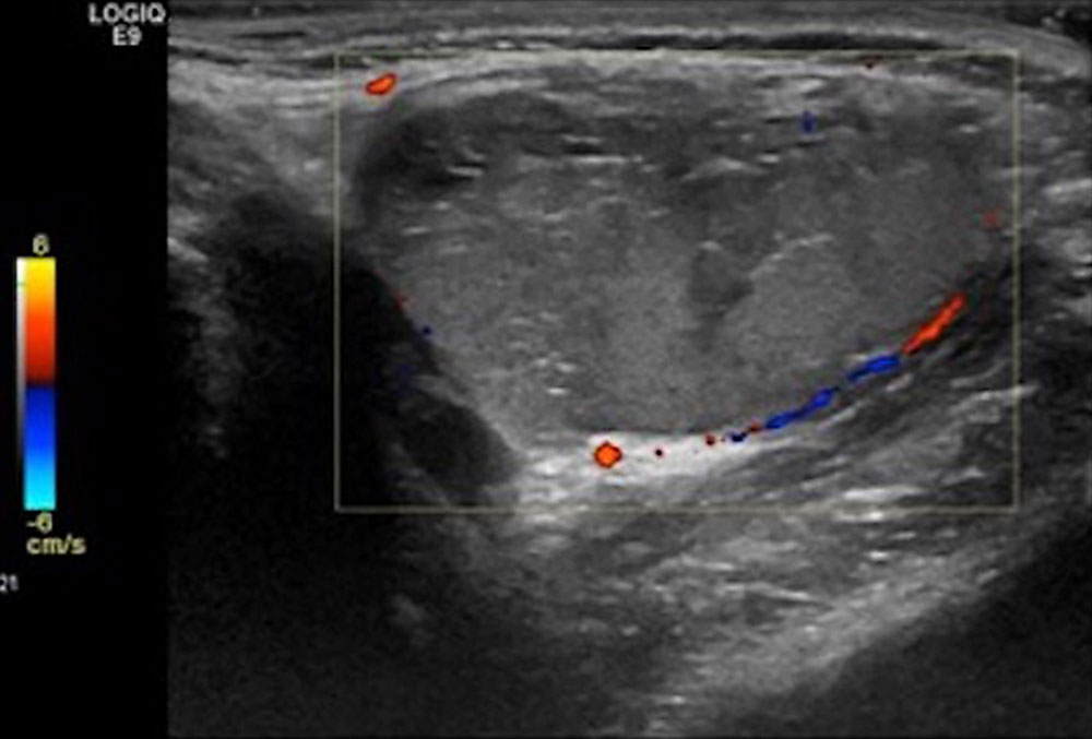 Farbkodierte Duplexsonographie einer venösen Malformation mit enthaltener Thrombophlebitis