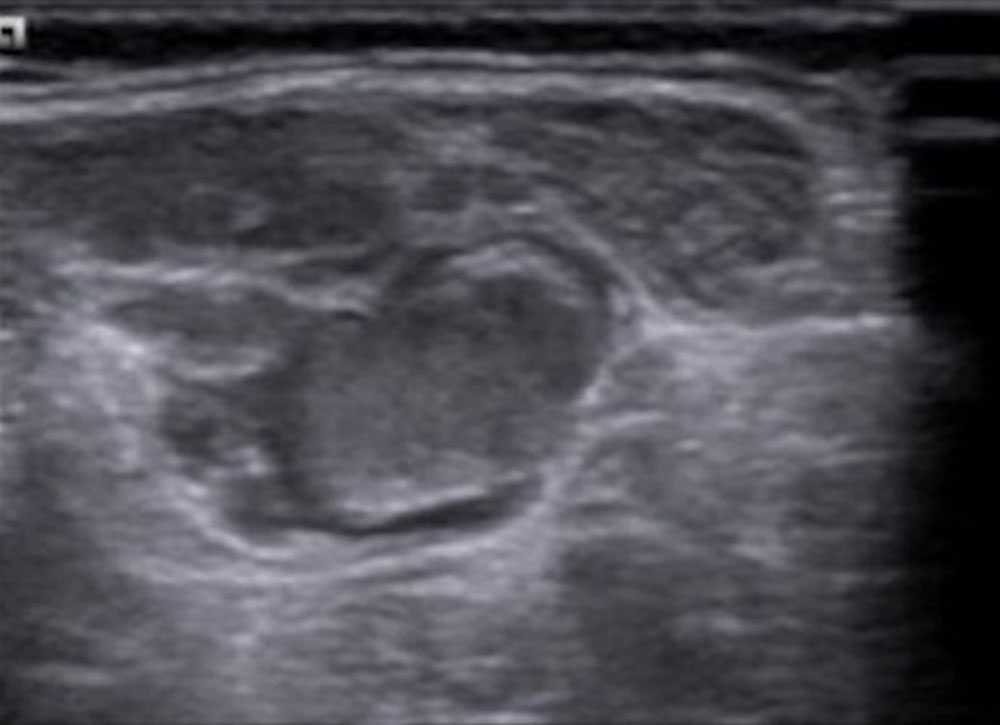 onographie einer Thrombophlebitis