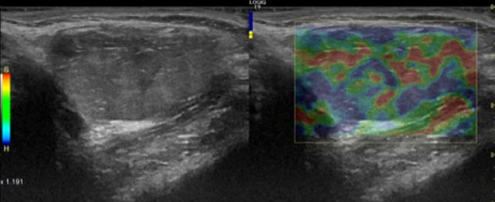 Ultraschall-Elastographie mehrerer Thromben bei venöser Malformation