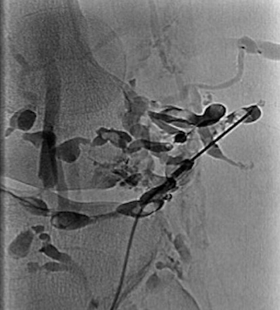 Varikographie einer venösen Malformation am Knie