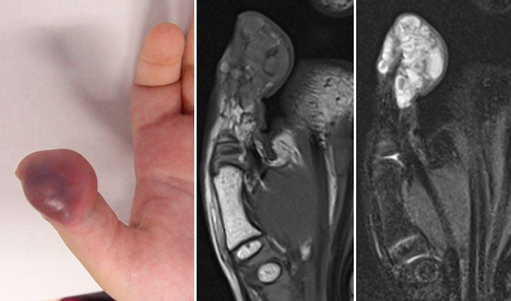 MRT – Thrombophlebitis an Daumen