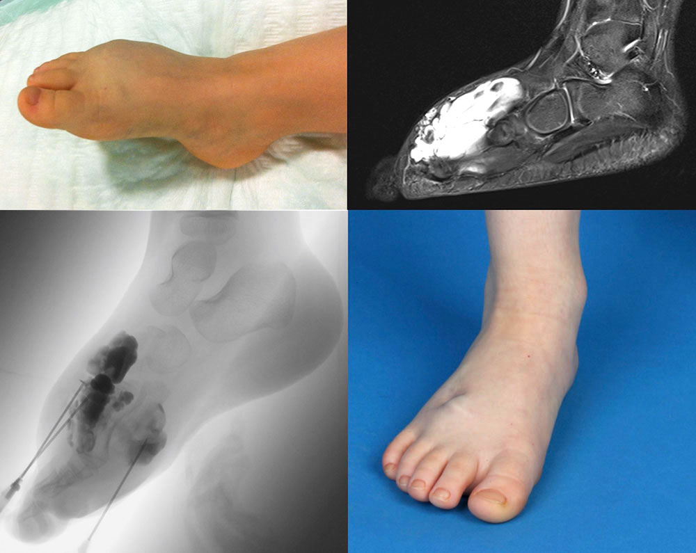 Thrombophlebitis mit  Schwellung am Fuß