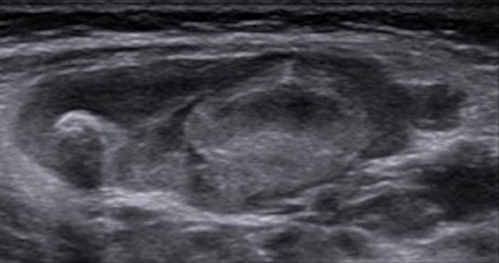 Sonographie von Thromben innerhalb einer venösen Malformation
