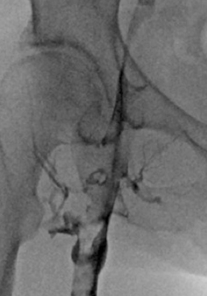 Thrombose in der Phlebographie