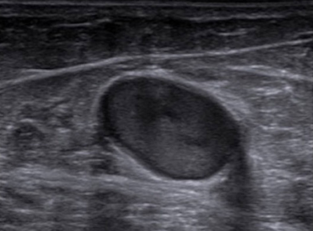 Sonographie von Muskelvenenthrombose in Unterschenkelvene