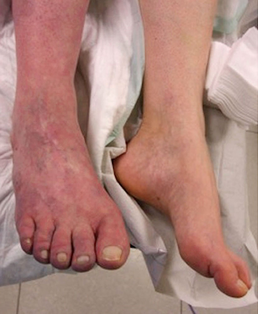 Komplette Thrombosierung des venösen Abstroms – Bein
