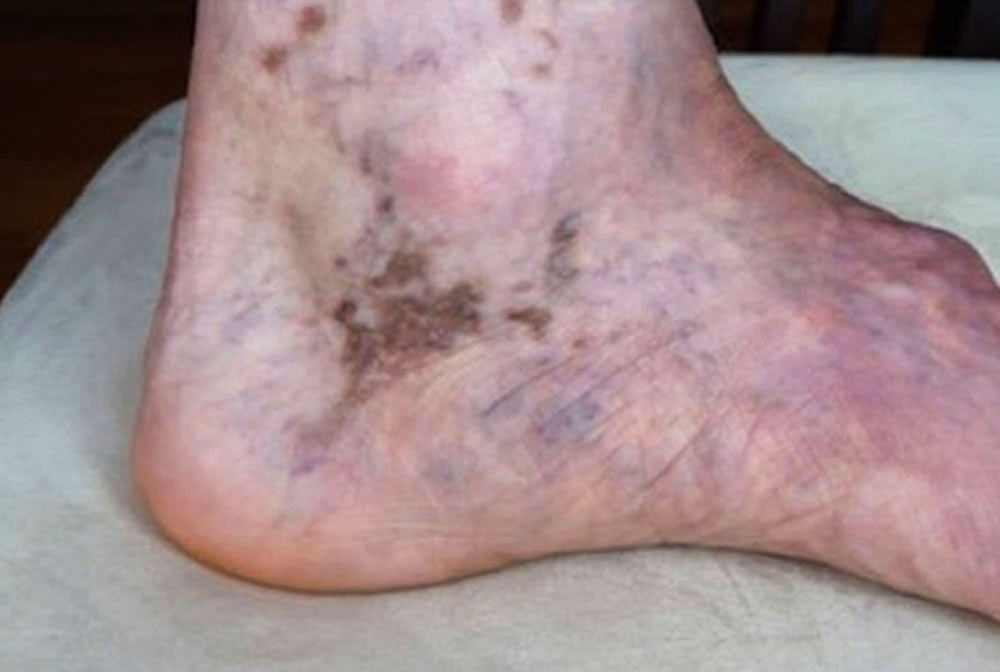 Purpura jaune d'ocre bei kombinierten kapillär-venösen Malformation des Beins