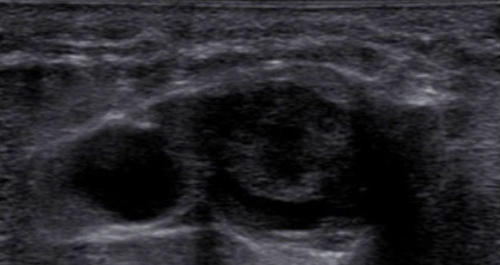 Sonographie von akuter Thrombose der rechten Vena femoralis communis