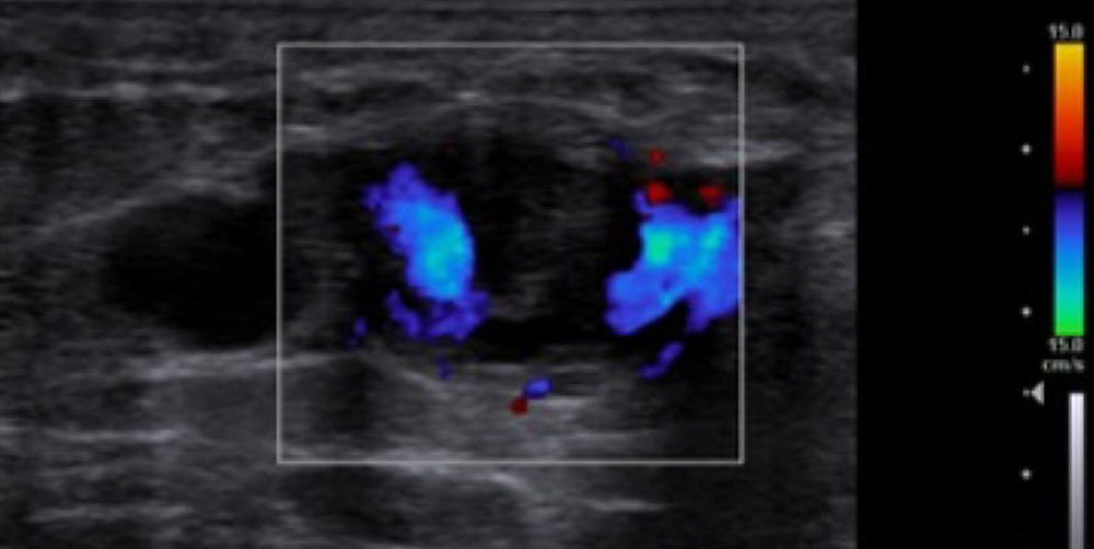 Farbkodierte Duplexsonographie von Thrombus