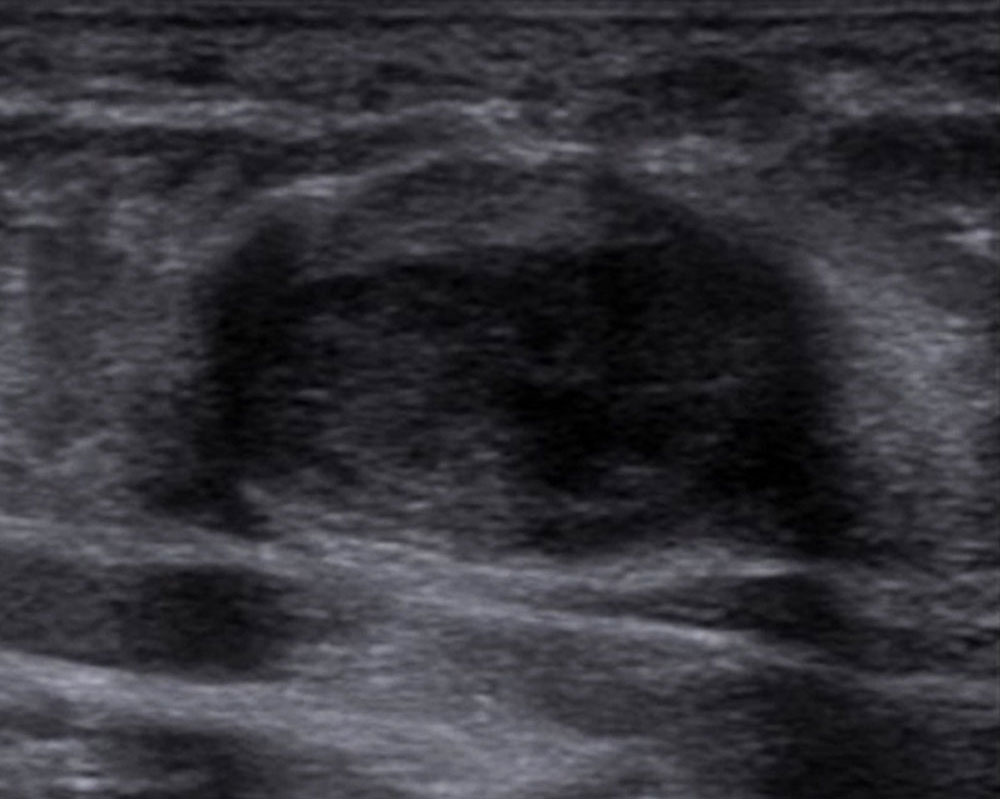 Sonographie – Thrombus