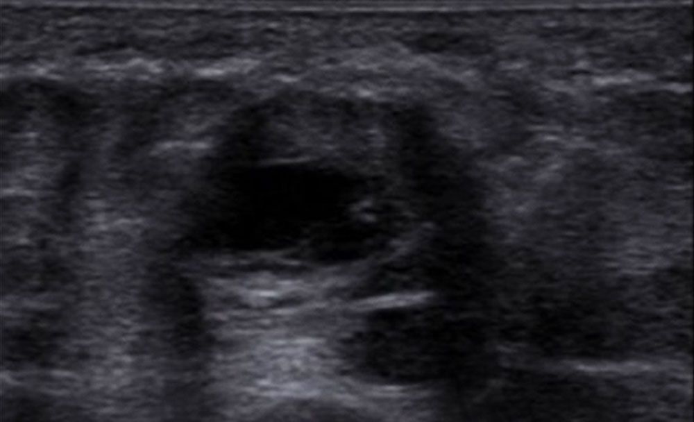 Sonographie – Thrombus