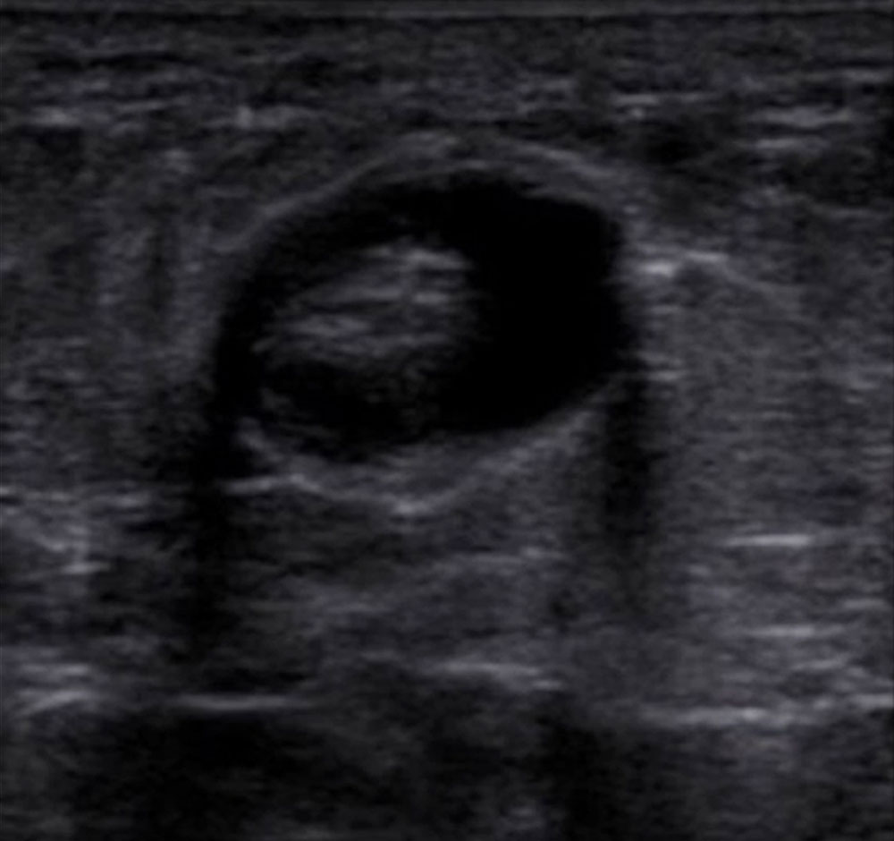 Sonographie – Thrombus