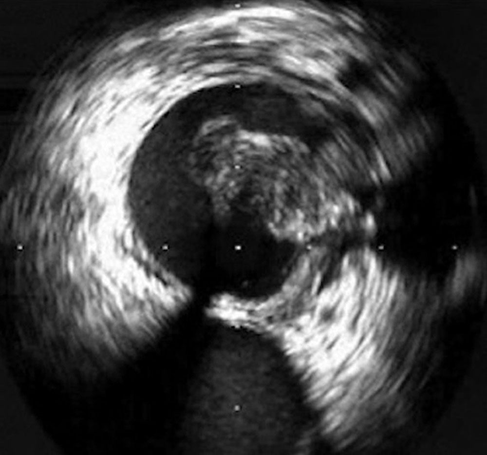Thrombus in der Vena iliaca communis bei May-Thurner-Syndrom