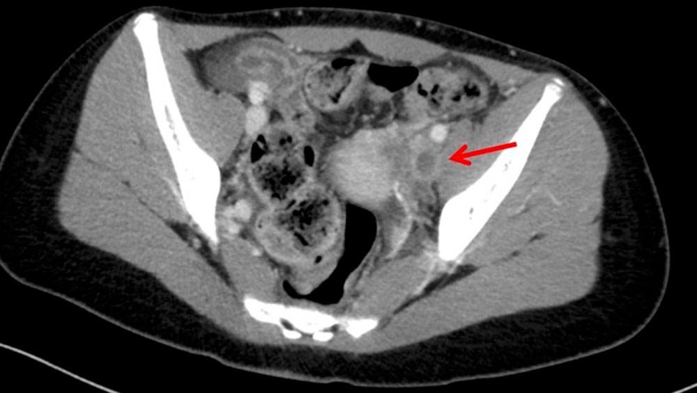 Computertomographie – Thrombose der linken Vena iliaca externa