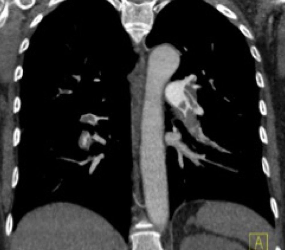 Lungenembolien in Spiral-CT-Angiographie