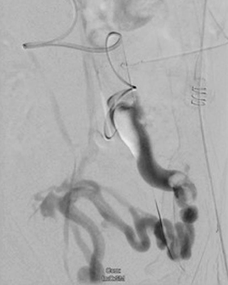 Subtraktionsphlebographie eines Thrombus