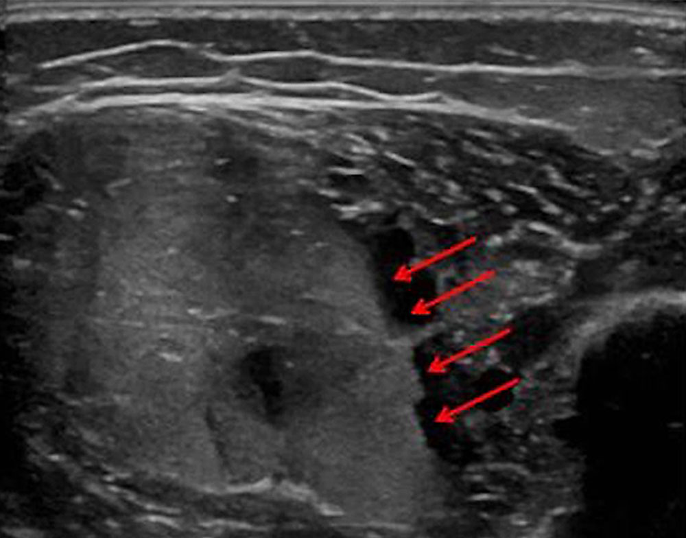 Sonographie einer venösen Malformation – Stase des Bluts