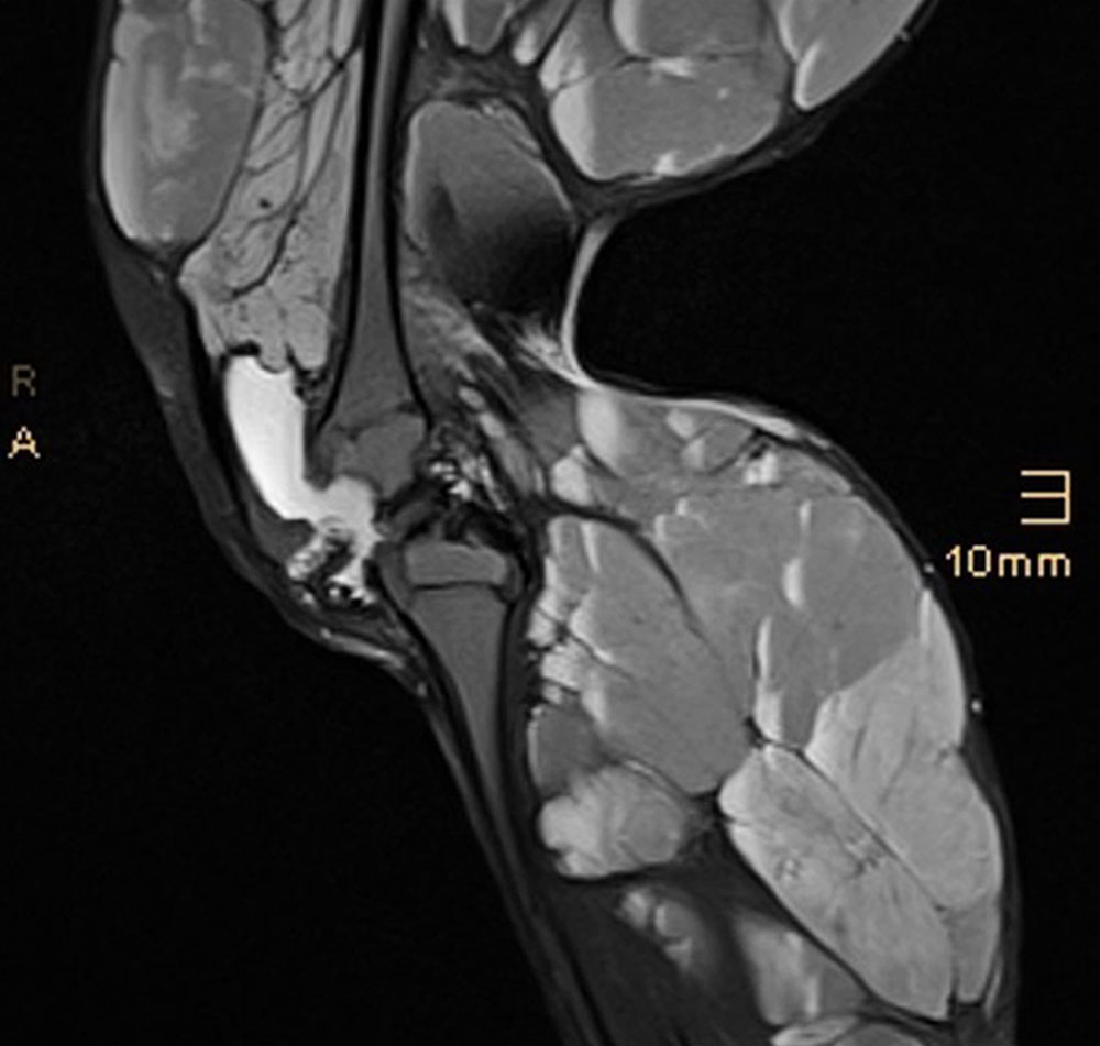 MRT – Venöse Malformation