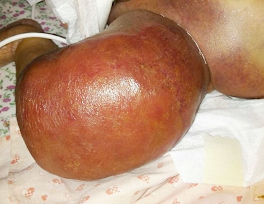 Kaposiformes Hämangioendotheliom bei Säugling