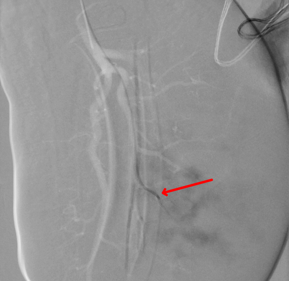 Embolisation bei Kasabach-Merrit-Phänomen