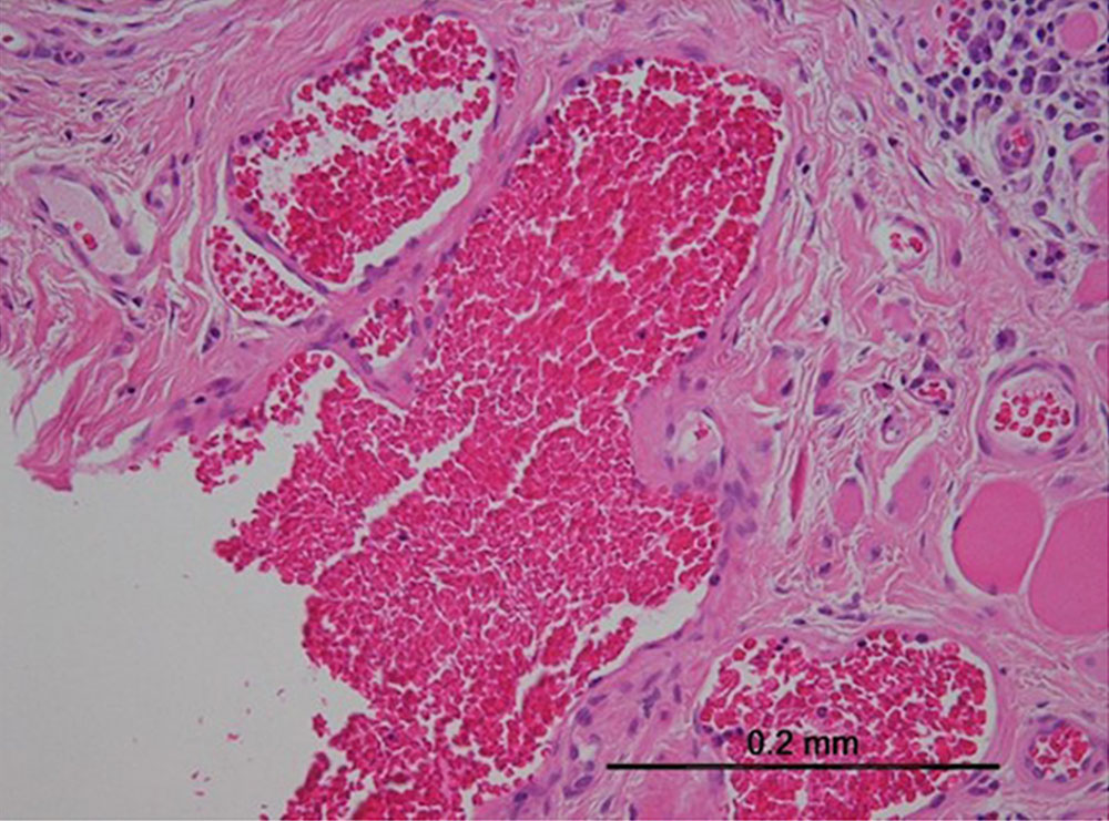 Histopathologisches Präparat – Venöse Malformation