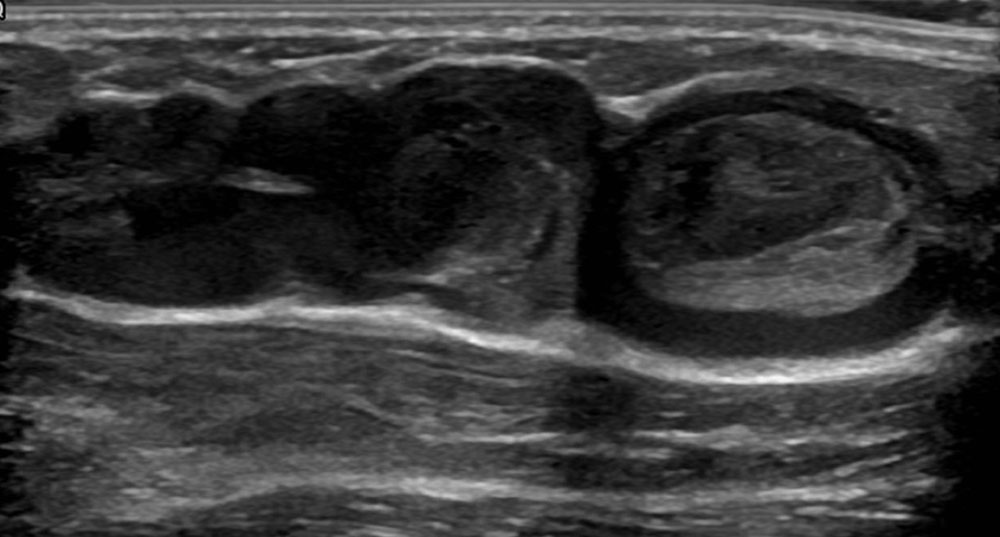 Sonogramm – Thrombophlebitis