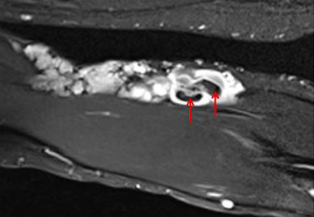 MRT – Thrombophlebitis