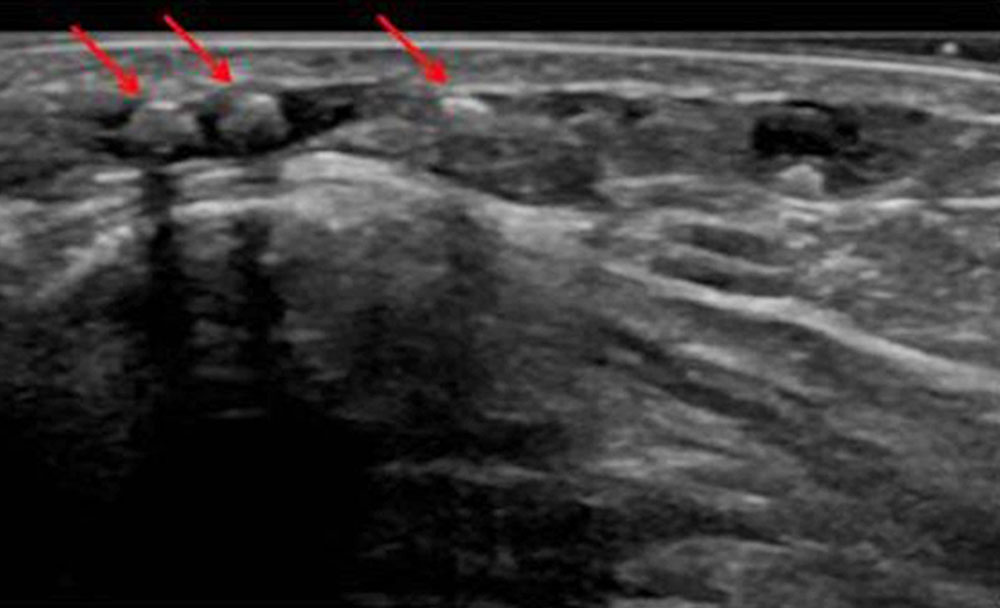 Sonographie – Phlebolithen